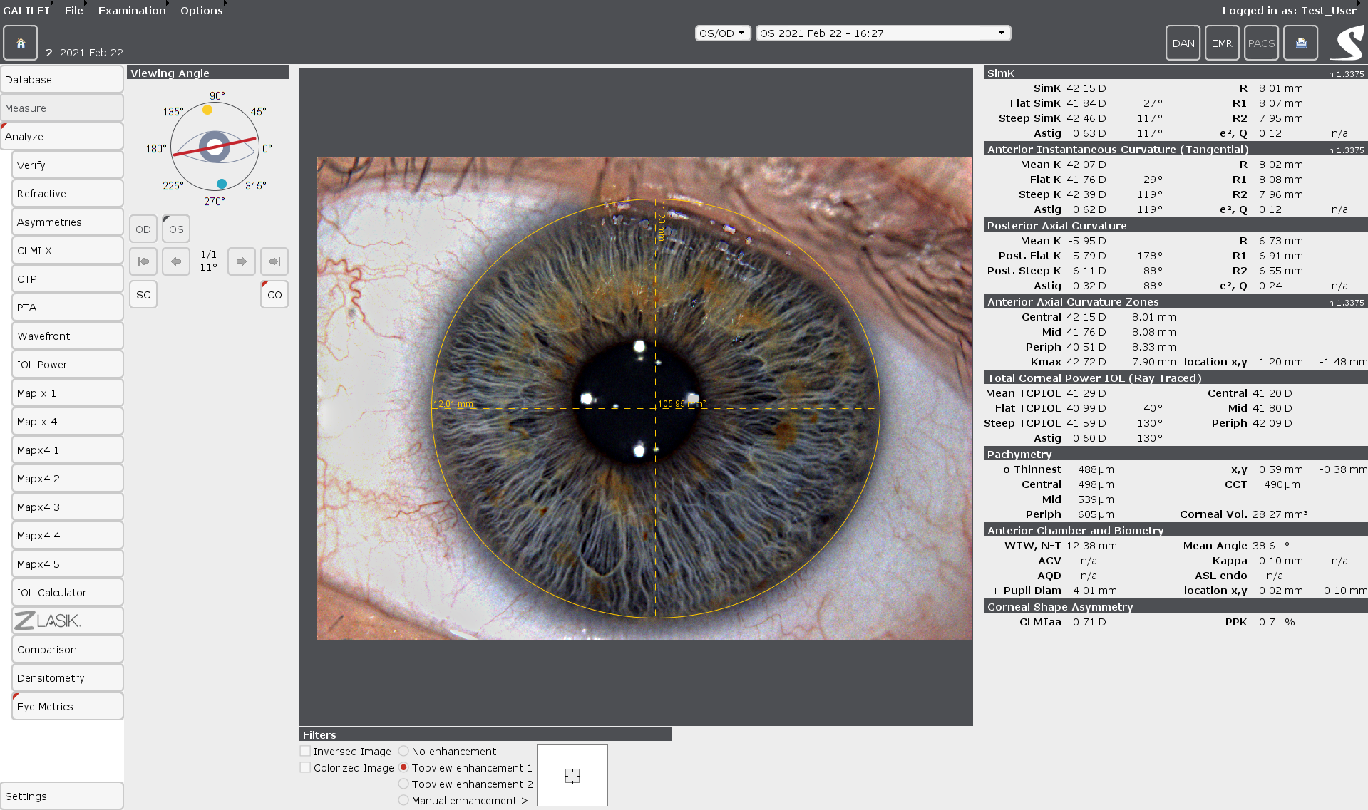 The Color Eye Metrics display can be used for different surgeries. Opacities can be located within the cornea. 