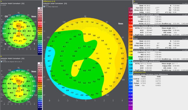 The Comparison Display provides a difference map to allow for comparing two measurements taken at different times and highlighting corneal changes.