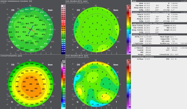 Quick visual screening for asymmetries with anterior and posterior elevation data that can easily be put in relation to corneal thickness.