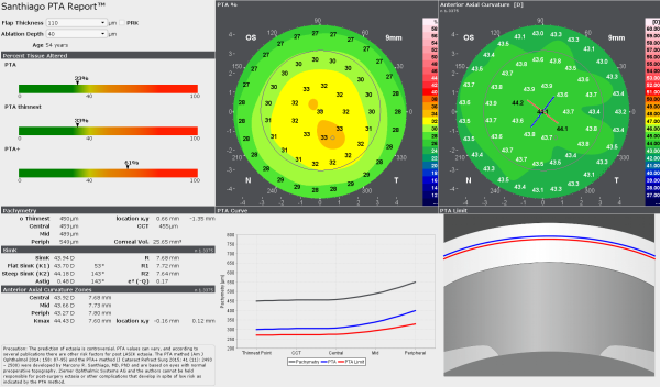Der Santhiago PTA Report™ ist ein Simulations-Tool, das verwendet wird, um die Wahrscheinlichkeit für die Entwicklung einer Ektasie in Augen mit präoperativ normaler Topographie nach einer LASIK vorherzusagen. 