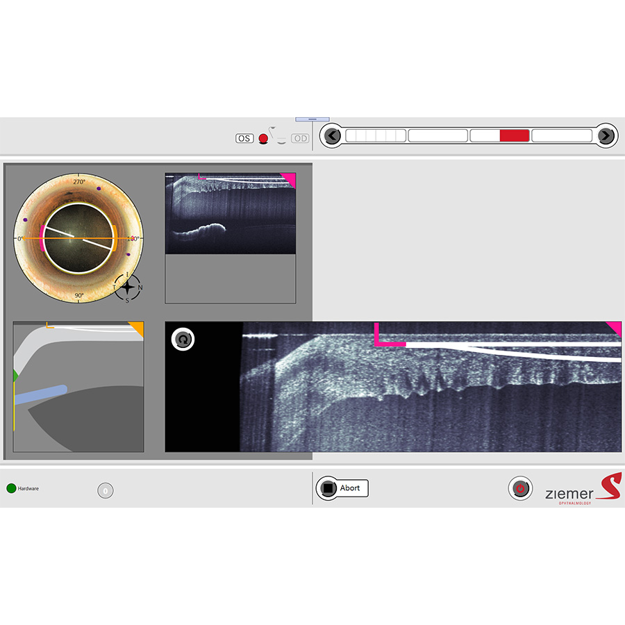 OCT imaging allows for automated ocular surface mapping and edge detections and provides a live view throughout all stages of the refractive, cataract or therapeutic procedure.