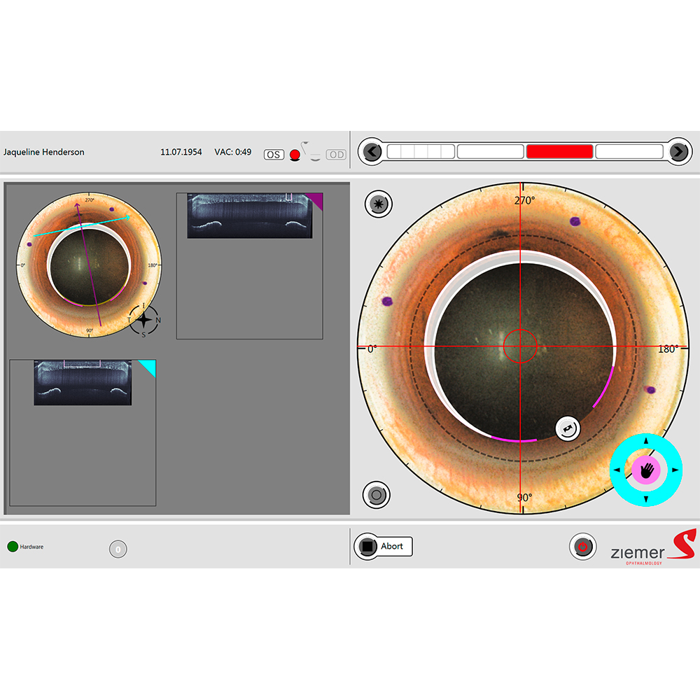 Arcuate resection - the arcuate resection module on the FEMTO Z8 allows the creation of customized crescent shapes within the cornea.
