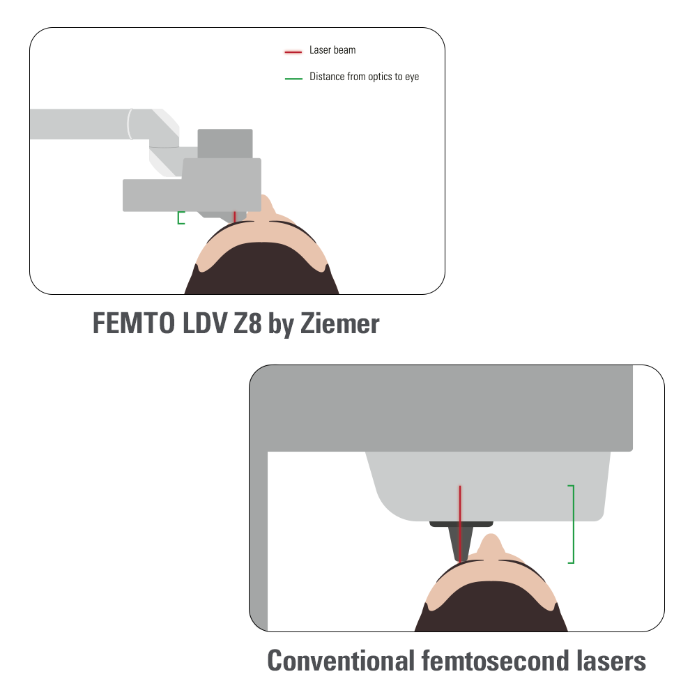 CLEAR / Ziemer Ophthalmic Systems AG