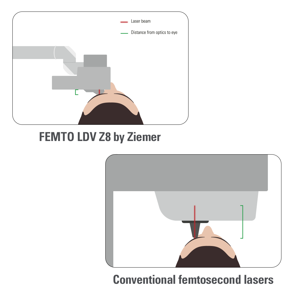 Thanks to the Ziemer handpiece there is a very short working distance to the eye. Therefore, a high focusing power can be achieved and only very little energy per pulse is needed. This allows for small overlapping spots resulting in a smooth cut.