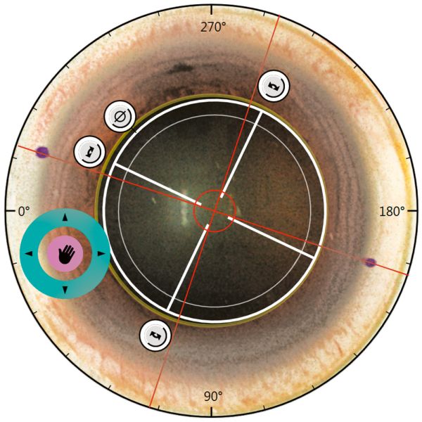 Easy centration on the eye, Repositioning of Lenticule under suction is possible, Compensation for cyclotorsion, Different centration options are possible: Pupil Center, Fixation Light, Corneal Marks 