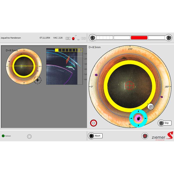 Liquid penetrating keratoplasty - The new liquid penetrating keratoplasty application on the FEMTO Z8 preserves the natural corneal curvature during the laser trephination process. 