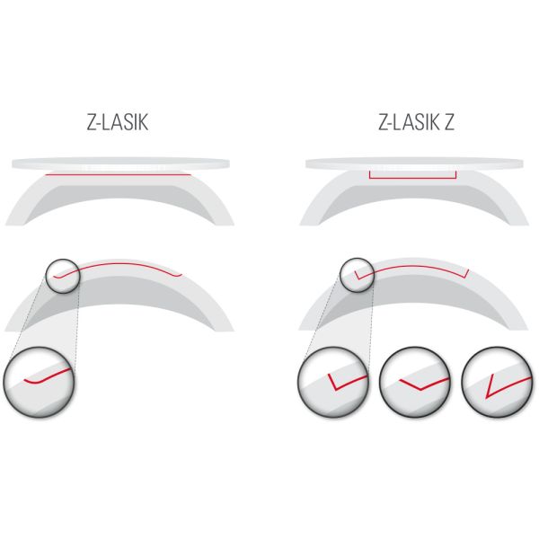 Choose between two LASIK cutting patterns: Z-LASIK pattern for a large, two-dimensional planar cut; Z-LASIK Z pattern for a side-cut, which allows re-centration of the flap under suction.