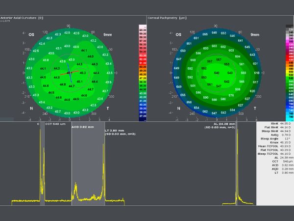 Optical Biometry - The optical biometer measures the central corneal thickness, the anterior chamber depth, the lens thickness and the axial length within the same exam. 
